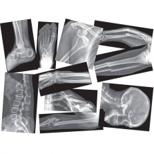 Roylco(R) Broken Bones X-Ray Set